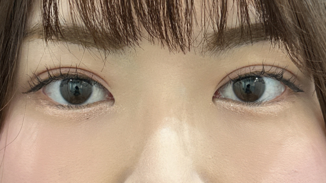 手术后的状态 其一