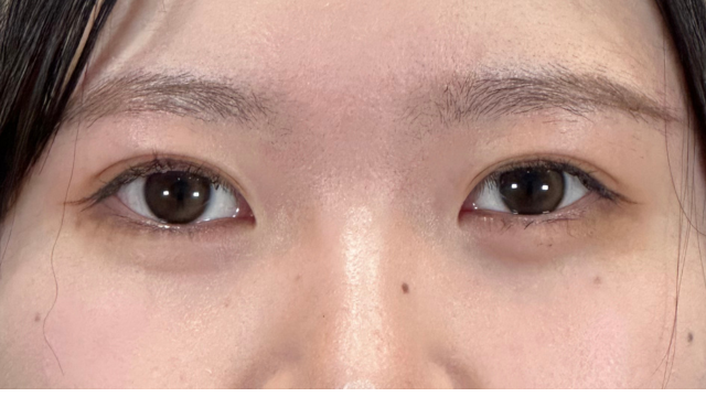 手术后的状态 其一