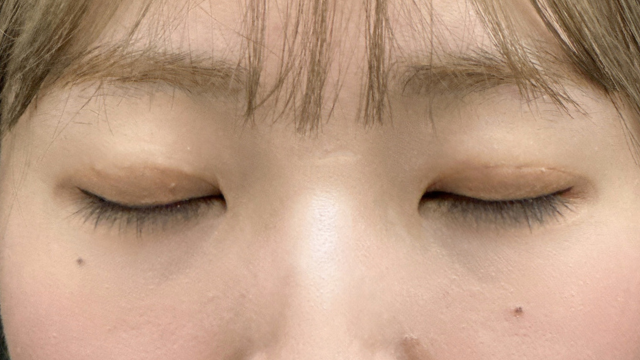 手术后的状态 其一