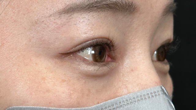 手术后的状态 其一