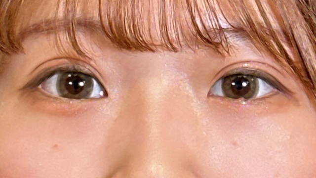 手术后的状态 其一