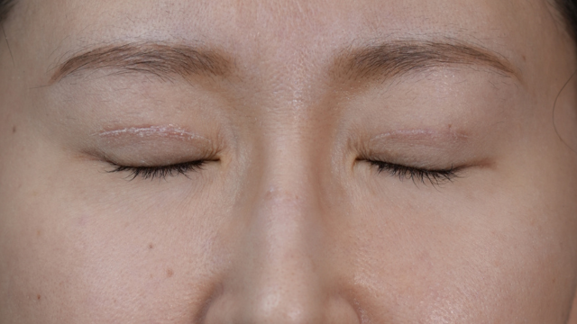 手术后的状态 其一