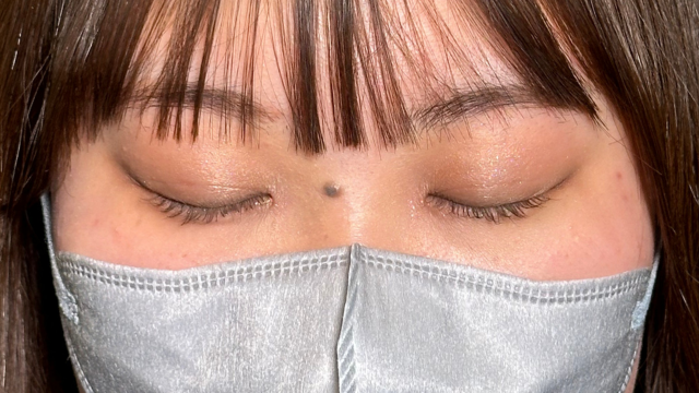 手术后的状态 其一