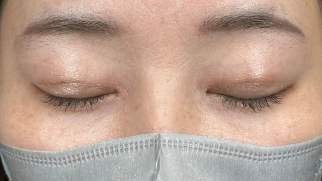 手术后的状态 其一