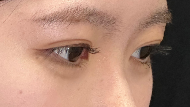 手术后的状态 其一