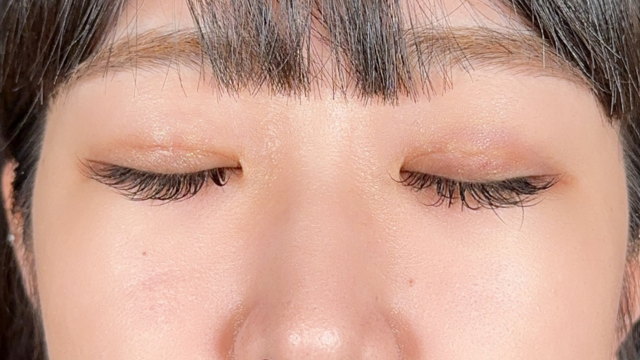 手术后的状态 其一