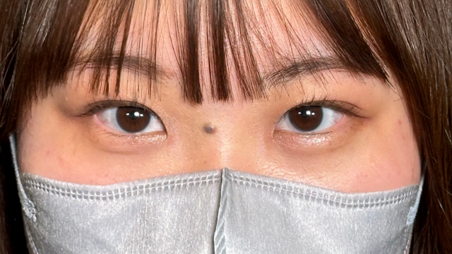 手术后的状态 其一