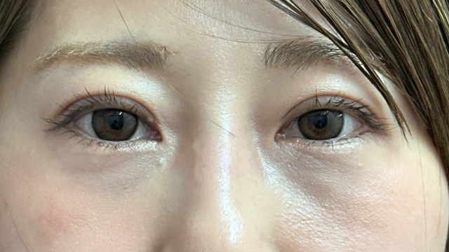 手术后的状态 其一