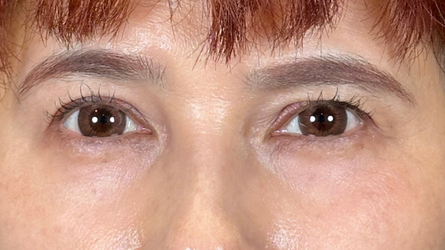 手术后的状态 其一