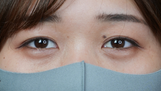 手术后的状态 其一