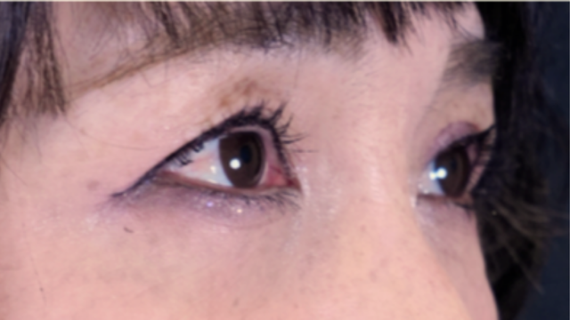 手术后的状态 其一