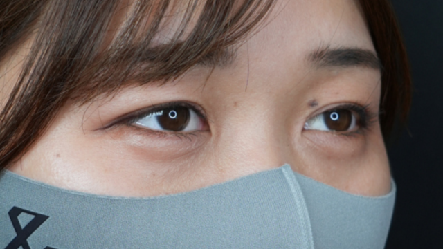 手术后的状态 其一