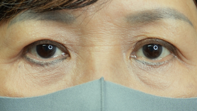 手术后的状态 其一