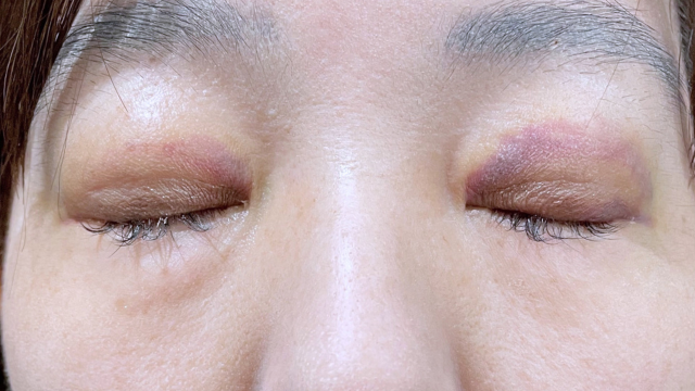 手术后的状态 其一