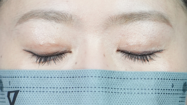 手术后的状态 其一