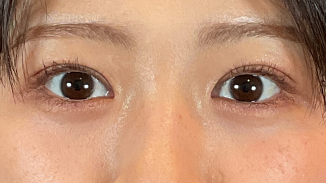 手术后的状态 其一