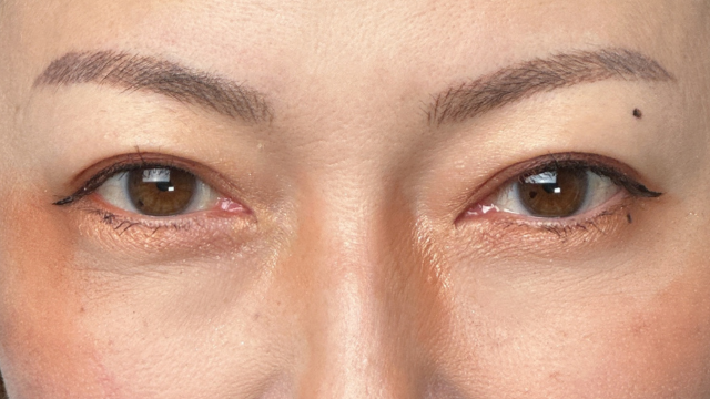 手术后的状态 其一