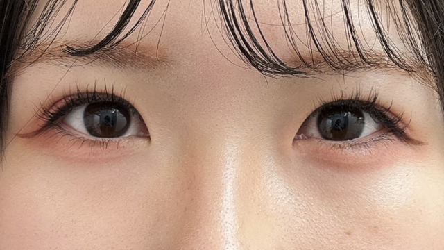 手术后的状态 其一