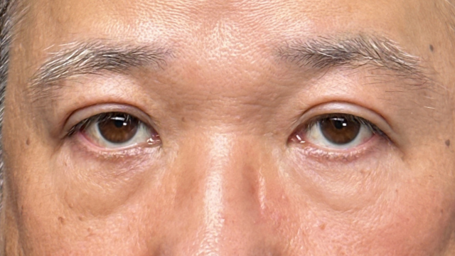 手术后的状态 其一