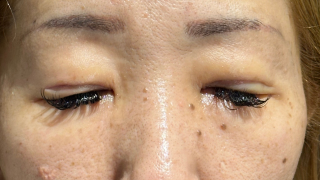 手术后的状态 其一