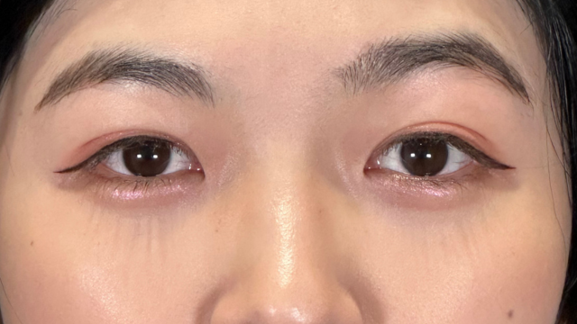 手术后的状态 其一