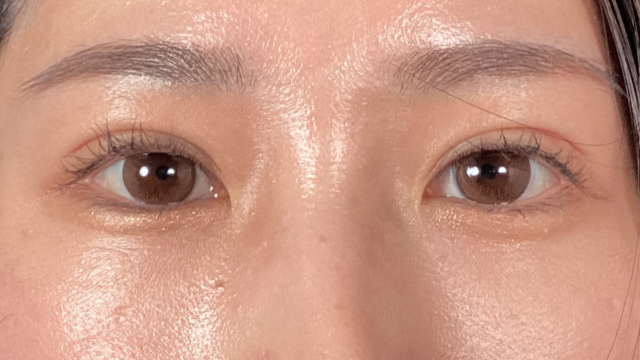 手术后的状态 其一