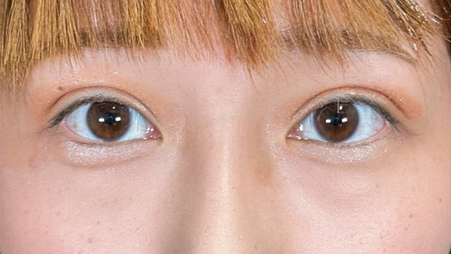 手术后的状态 其一