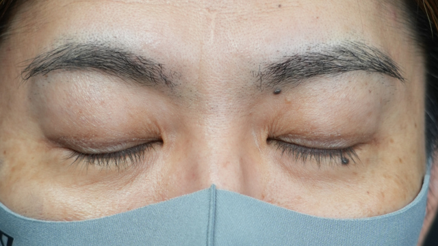 手术后的状态 其一