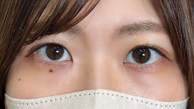 手术后的状态 其一