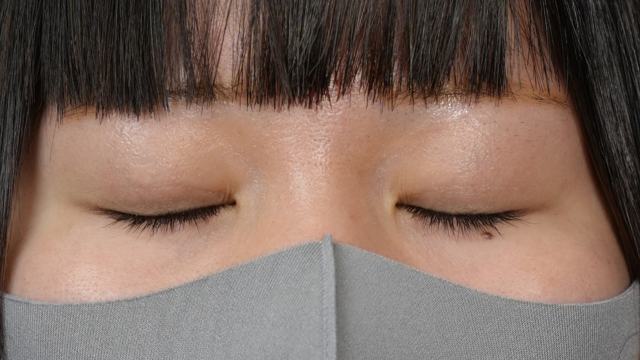 手术后的状态 其一