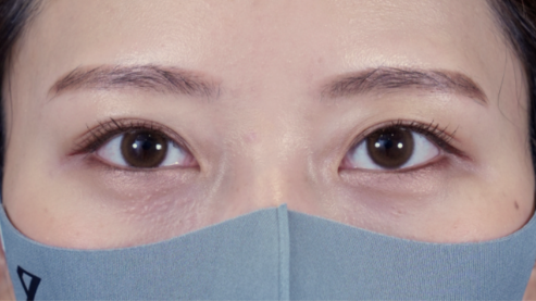 手术后的状态 其一