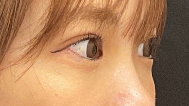 手术后的状态 其一