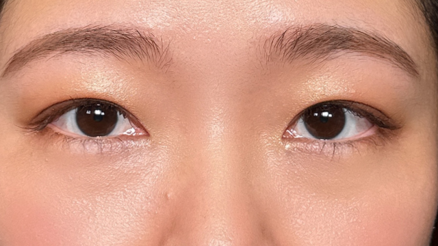 手术后的状态 其一