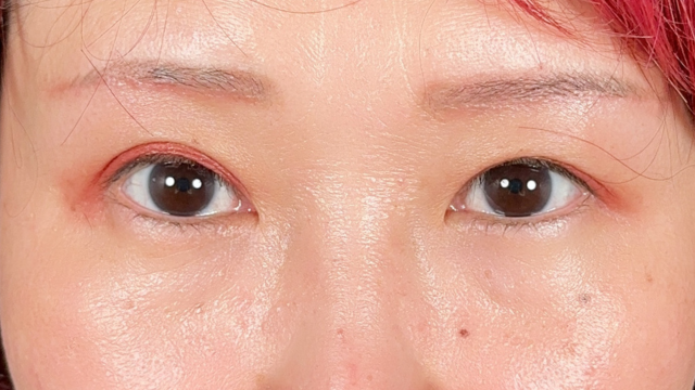 Postoperative Condition Part 1