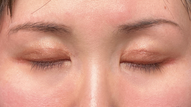 Postoperative Condition Part 1