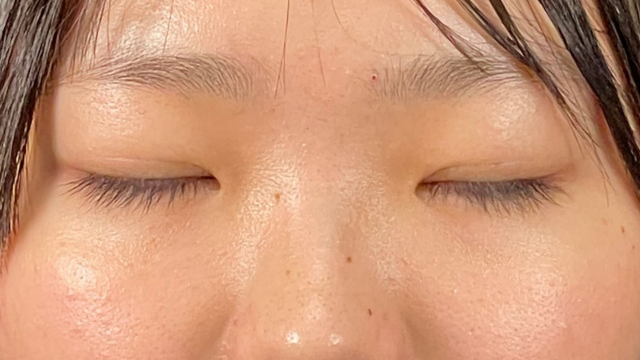 Postoperative Condition Part 1