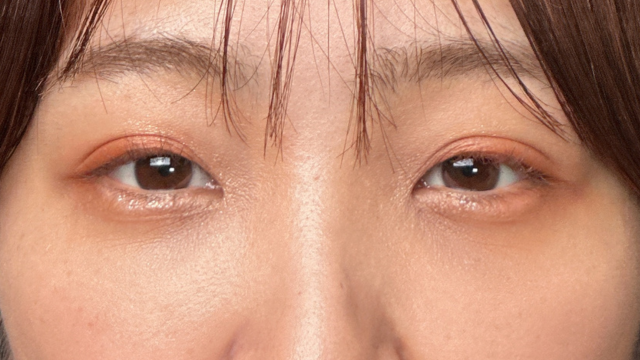 手术后的状态 其一