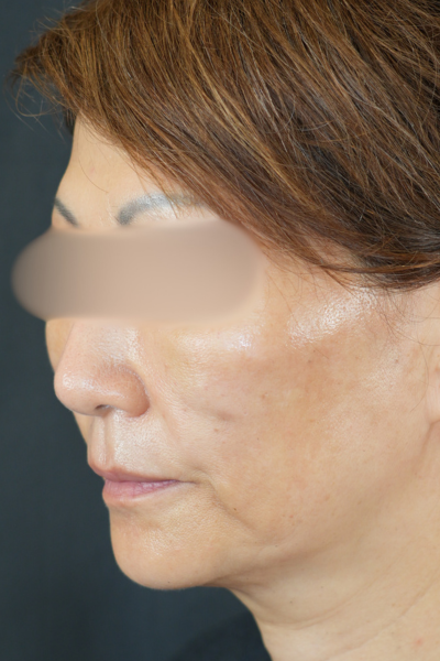 手术后的状态 其一