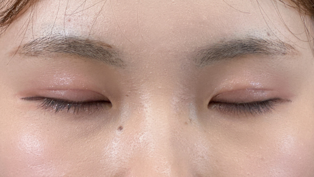 Postoperative Condition Part 1