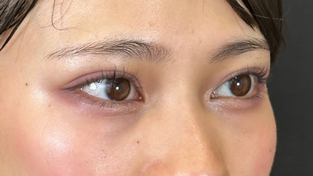 手术后的状态 其一