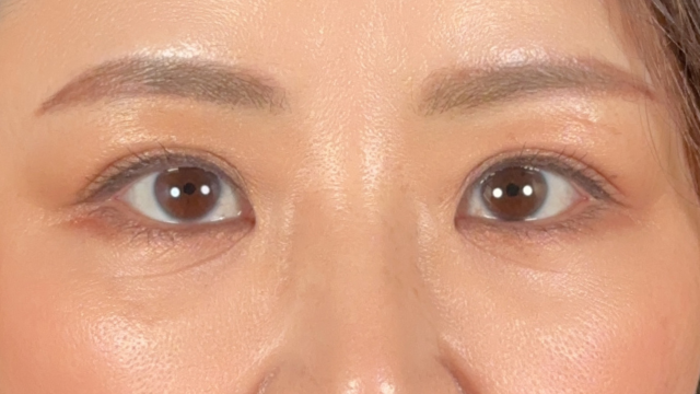 手术后的状态 其一