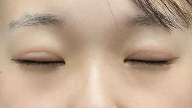 手术后的状态 其一