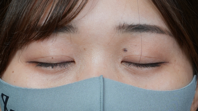 手术后的状态 其一