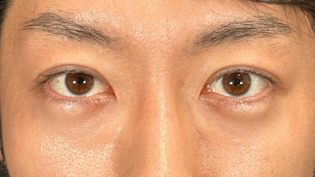 手术后的状态 其一