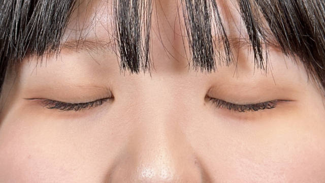 手术后的状态 其一