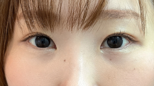 手术后的状态 其一