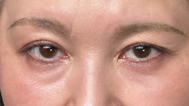 手术后的状态 其一