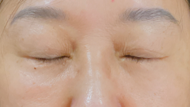 手术后的状态 其一