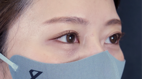 手术后的状态 其一