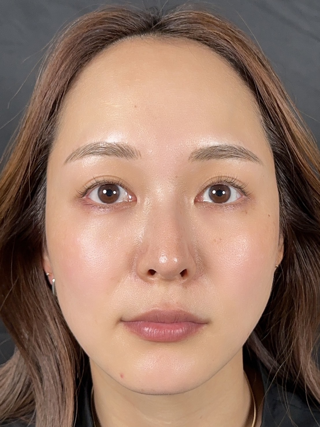 手术后的状态 其一